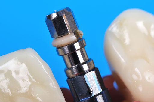 Dental-Implants