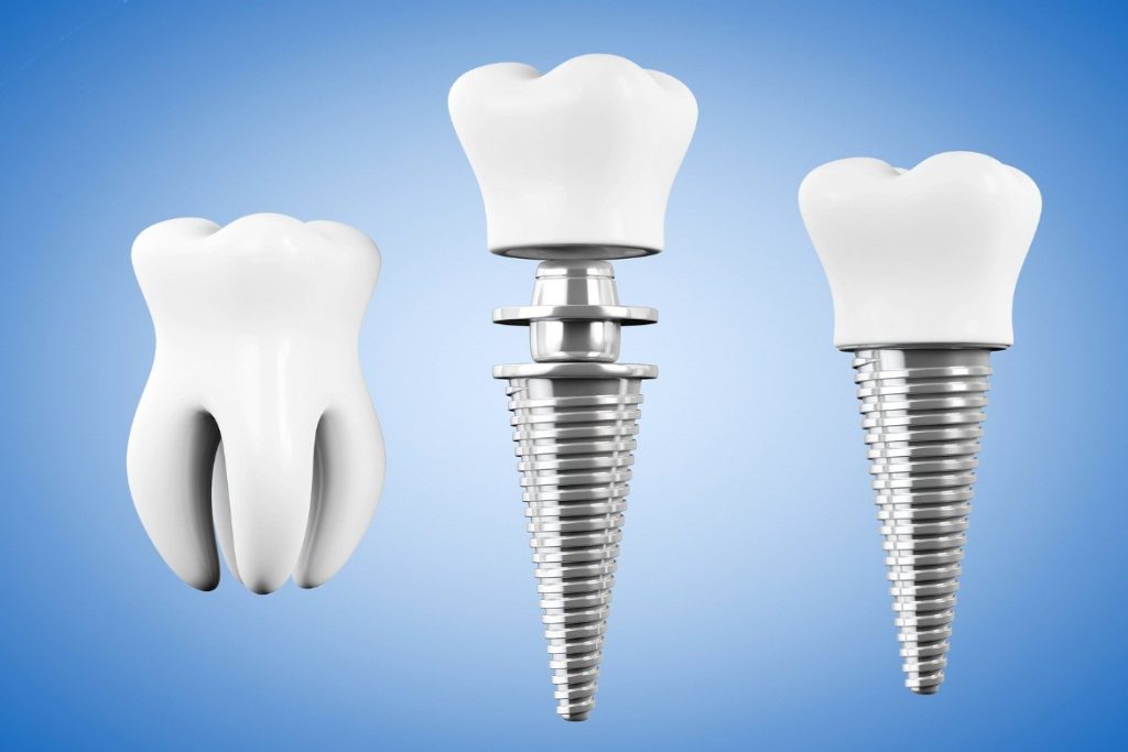 benefits-of-dental-implants