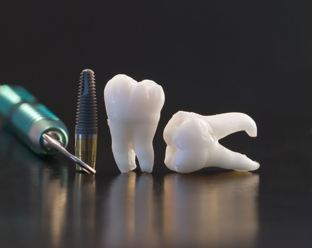 getting-dental-implants