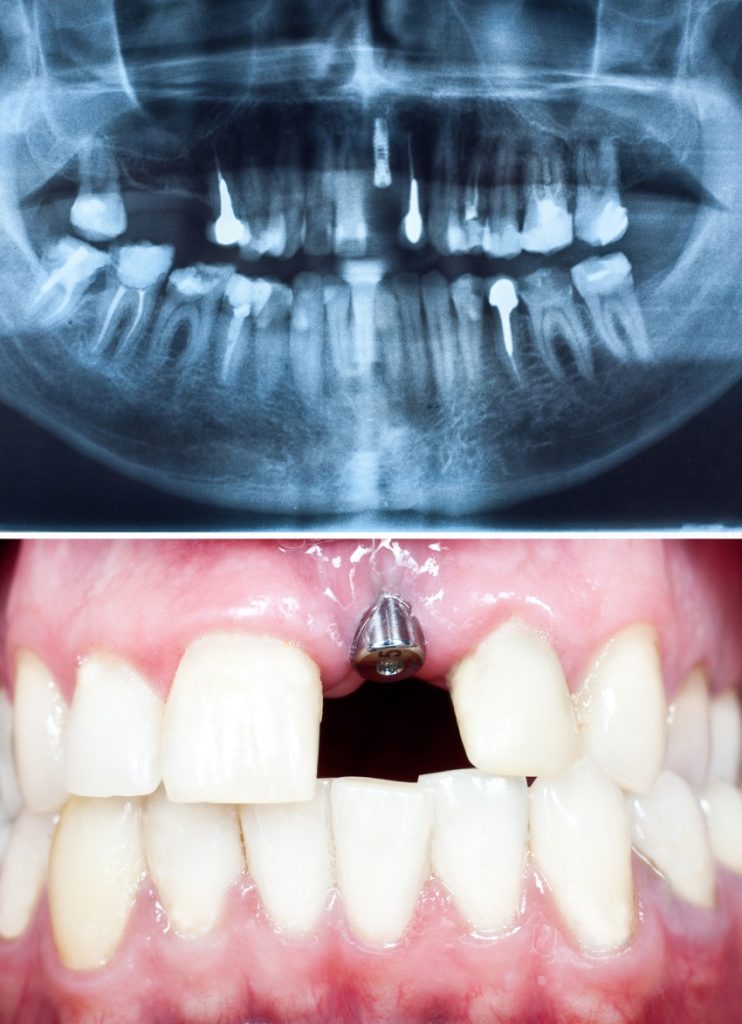 The Benefits of Dental Implants for People Experiencing Tooth Loss