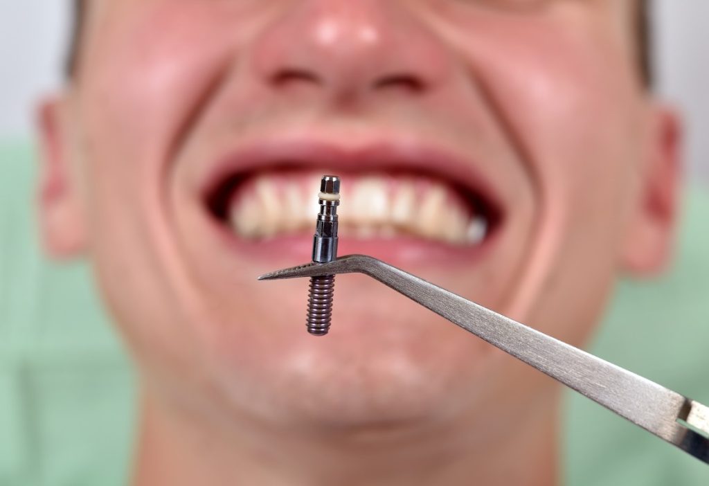 Dental Implants: How They Are Installed and What Their Benefits Are