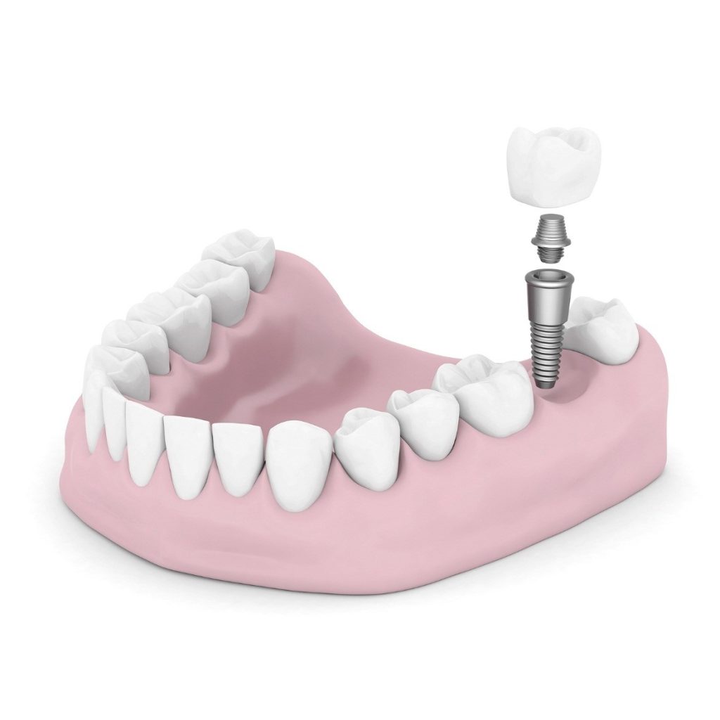 maintain-dental-implants