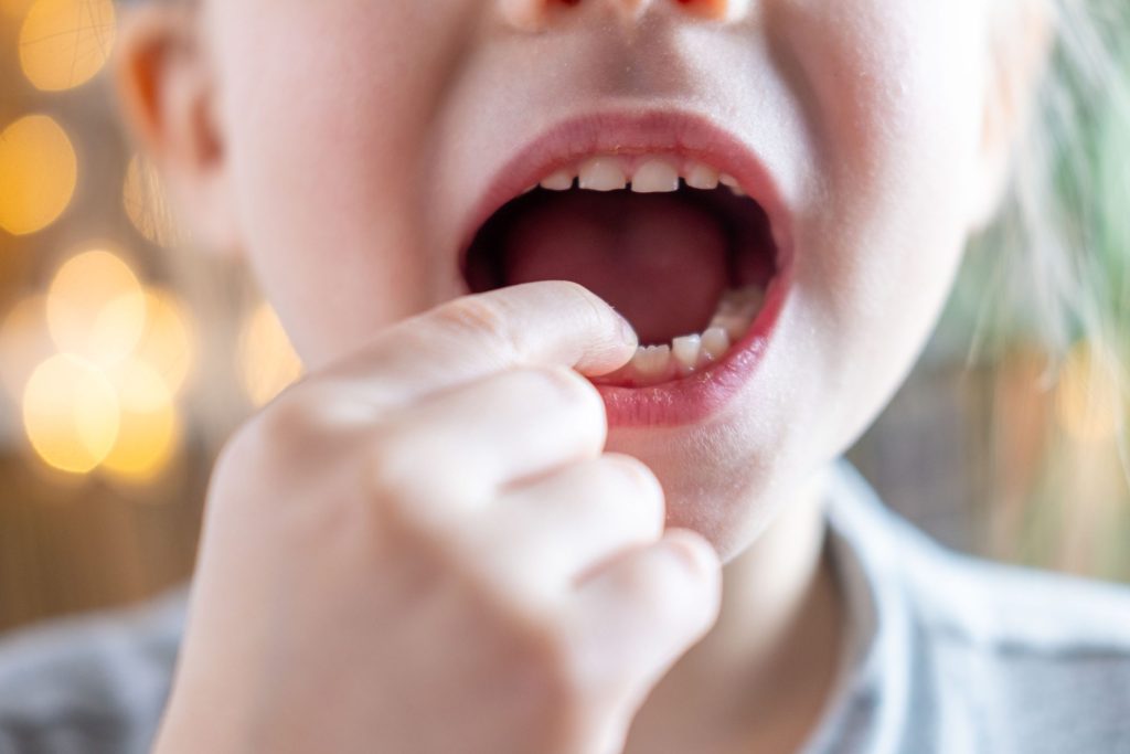 Do Kids Really Need Dental Sealants? What Parents Should Know