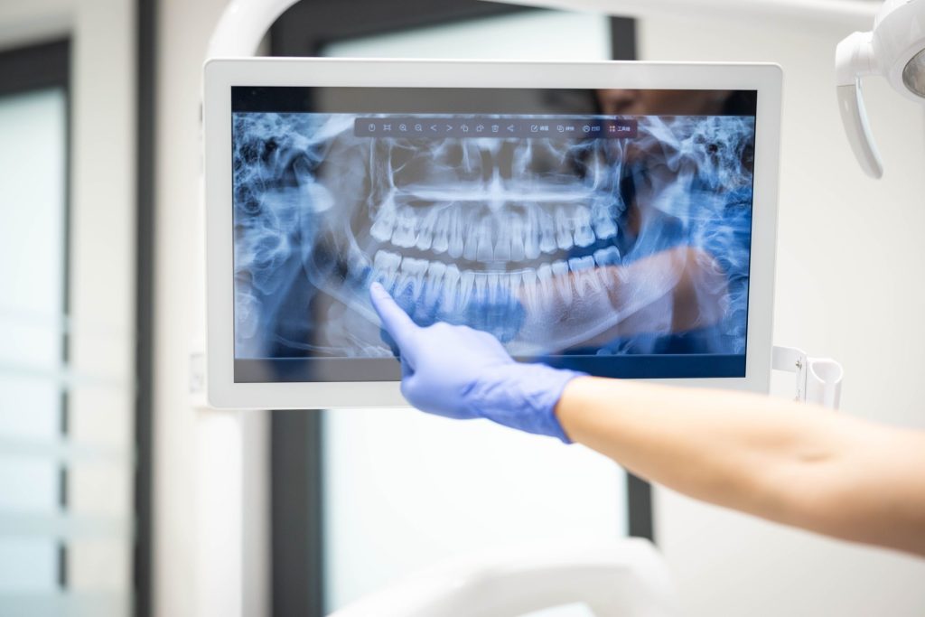 When Your Teeth Don’t Hurt, Why Would You Need Dental X-Rays?